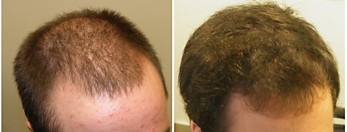 finasteride 1 year no results