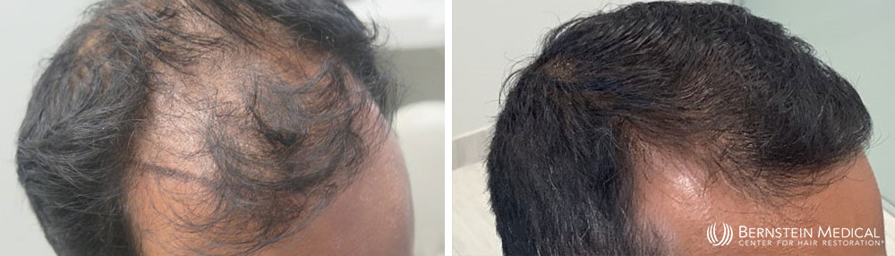 minoxidil before and after eyebrows