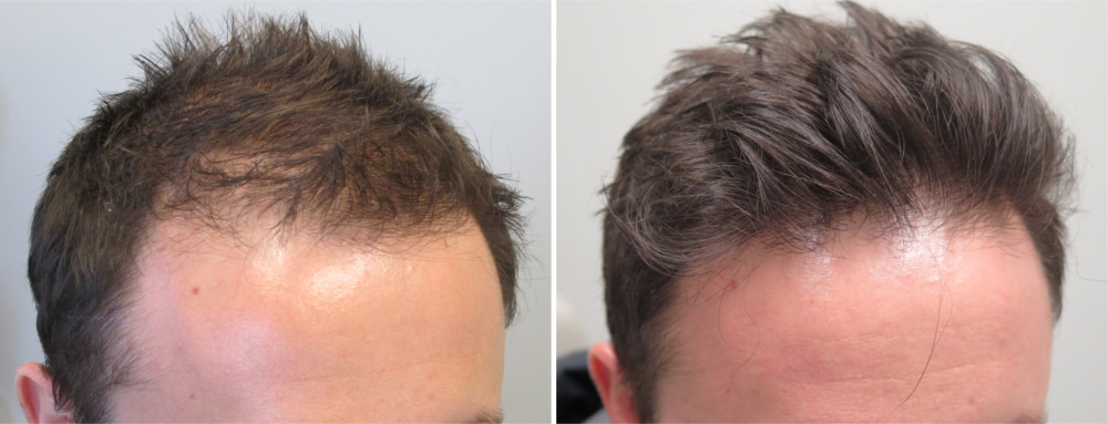 Is Finasteride 1mg Suitable For Treating a Receding Hairline