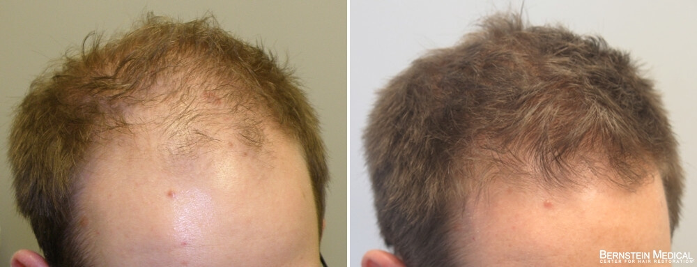 Propecia Rogaine Before After Photos  Bernstein Medical